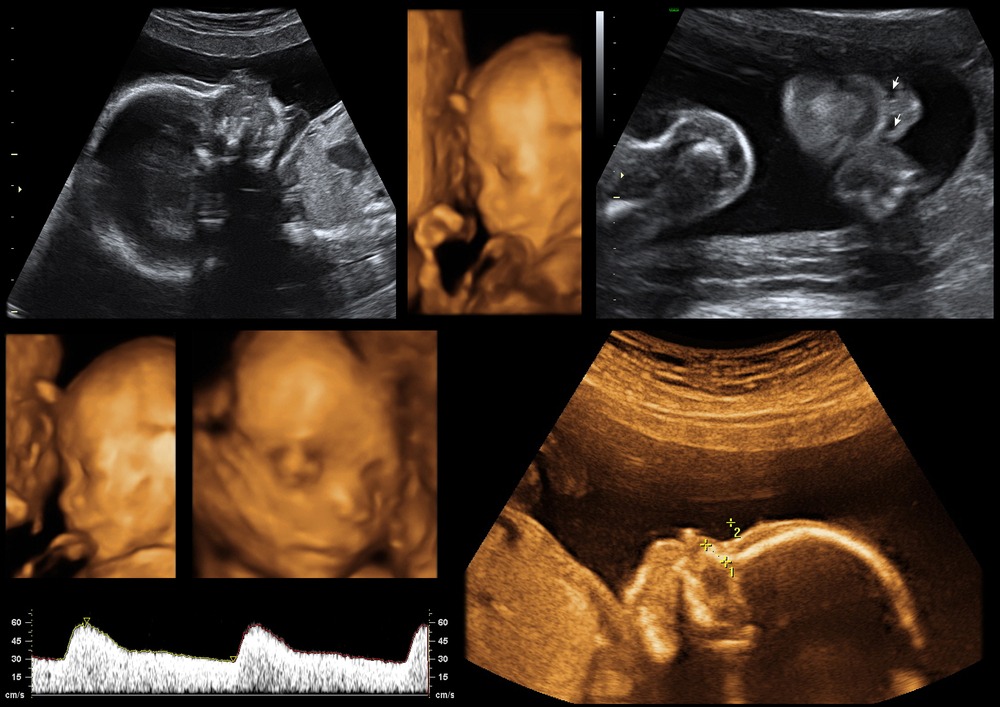 Understanding 3D and 4D pregnancy ultrasounds - International Ultrasound Services