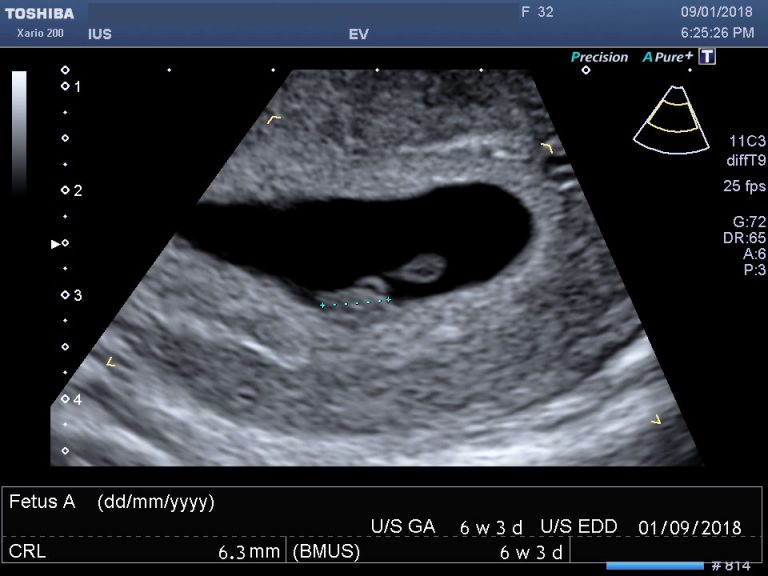 7 week ultrasound heartbeat