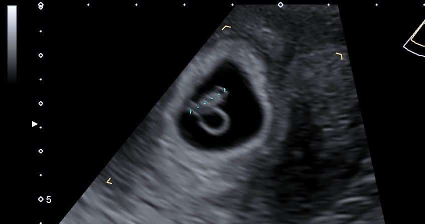 7 Week Baby Ultrasound Scan International Ultrasound Services