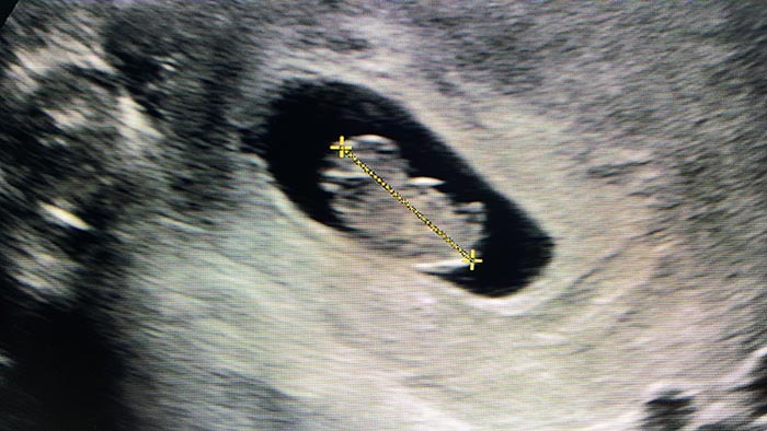 8 week ultrasound