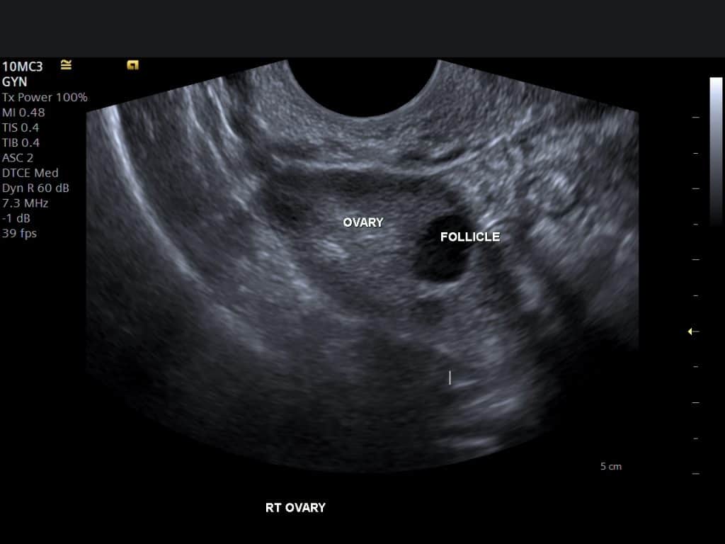 Ultrasound Evaluation of the Gravid Cervix