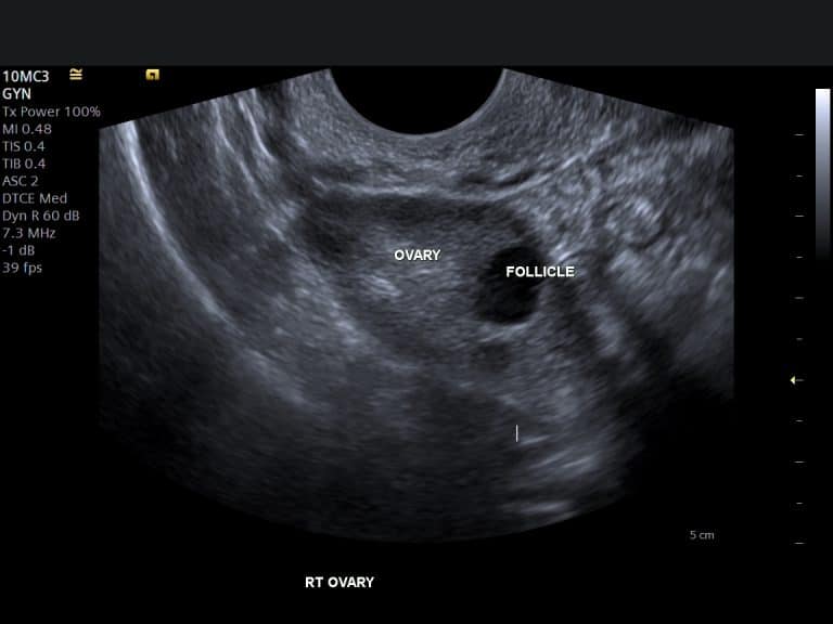 Read more about the article Polycystic Ovary Syndrome (PCOS) and the Role of Follicular Scans