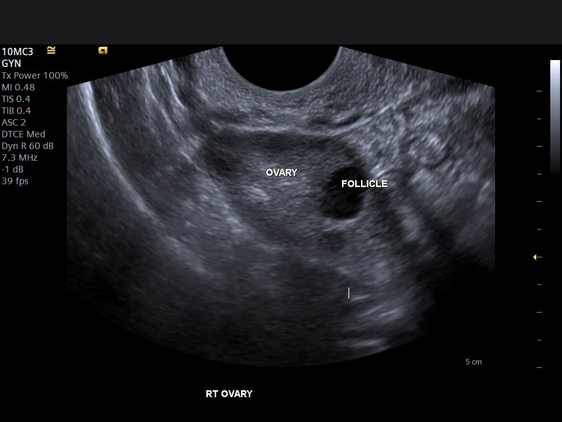 Understanding Pelvic Ultrasound Reports Pelvic Ultrasound Results Explained 