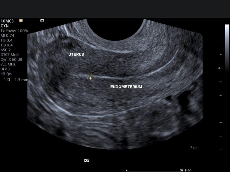 Understanding pelvic ultrasound reports | Pelvic Ultrasound Results ...